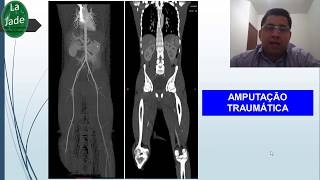 Angiotomografia de aorta e MMII CASOS [upl. by Zulema850]