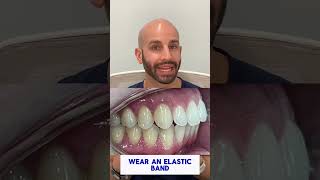 Invisalign And Elastic Bands To Fix Overbite [upl. by Mabelle932]