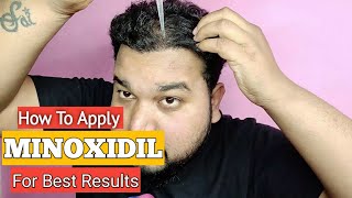 How To Apply Minoxidil For Best Result  best hair transplant result 2019 [upl. by Bixler]