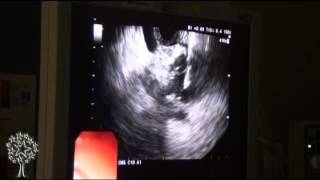 Endoscopic Ultrasound [upl. by Charil614]