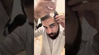 Hair Restoration day40 by Derma Stamp minoxidil haircare [upl. by Hersh]