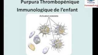 Purpura Thrombopénique immunologique physiopathologie diagnostic [upl. by Akemahs464]