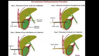 cholecystostomy percutaneous Gall bladder catheter drainage  percutaneous cholecystostomy [upl. by Sigismund]