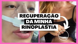 TIVE QUE TIRAR UM PEDAÇO DA COSTELA  7 meses da rinoplastia [upl. by Aicac250]