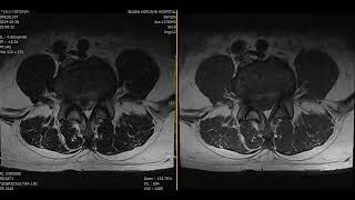 L45 Disc extrusion with mild inferior migration [upl. by Audri]