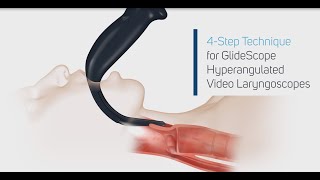 How to Intubate Using a GlideScope® Video Laryngoscope in 4 Steps [upl. by Booma]