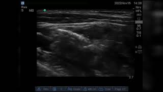 Ultrasound guided Costoclavicular brachial plexus block [upl. by Drannel]