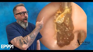 HOW TO SAFELY REMOVE A HUGE EAR WAX PLUG Earwax removal  EP991 [upl. by Bautista]