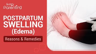 Postpartum Swelling Edema  Reasons and Remedies [upl. by Avitzur398]