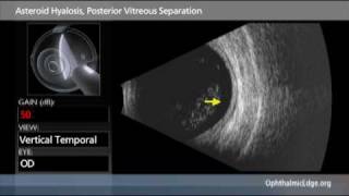 Asteroid Hyalosis Posterior Vitreous Separation [upl. by Nelehyram397]