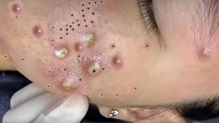 Big Cystic Acne Blackheads Extraction Blackheads amp Milia Whiteheads Removal Pimple Popping  3766 [upl. by Ahsinyar230]