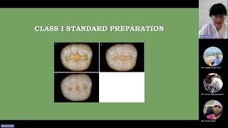 II2  Classification of carious cavities according to Black Basic principles of preparation [upl. by Nauh]