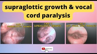 supraglottic growth  vocal cord paralysis  70degree endoscopy [upl. by Airetnohs]