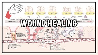 Wound Healing  Stages of healing and pathology [upl. by Relluf]