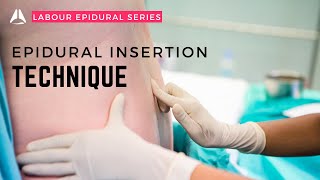 The Epidural Insertion  anesthesiology anesthesia analgesia epidural [upl. by Belding500]