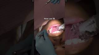 How to do Fillings and Cavities way Faster [upl. by Alyose]