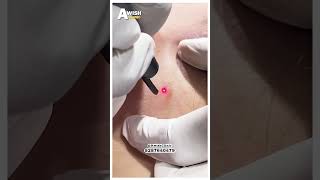 Mole removal by laser vs Cautry vs Excision [upl. by Anitsua]