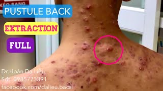 Mụn trứng cá mủ lưng cực nặngDermatologistpimpleswhiteheadacne conglobata pustule extraction ful [upl. by Ztnaj]