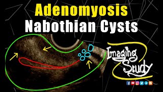 Adenomyosis with Nabothian Cysts  Ultrasound  TVS  Case 255 [upl. by Kcirb535]