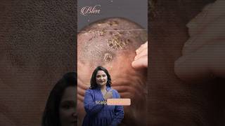 Scalp Psoriasis Treatment  Skin Doctor in Ludhiana  Dr Shikha Aggarwal [upl. by Aidua]