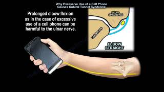 Did you know excessive Use of a Cell Phone can aggravate Cubital Tunnel Syndrome symptoms [upl. by Annam]