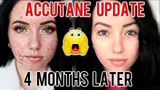 MY ACCUTANE JOURNEY 4 MONTH UPDATE Before amp After Progress Side Effects [upl. by Jaban891]