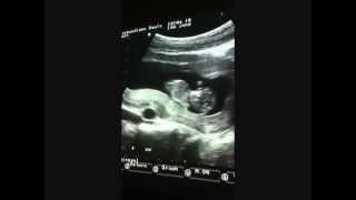 pregnancy 11 weeks 4 days ultrasound [upl. by Mcgrody]