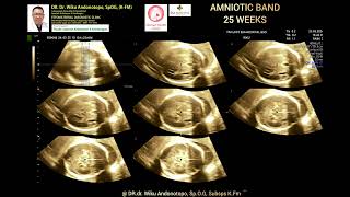 Amniotic Band syndrome 25 weeks [upl. by Nannoc797]