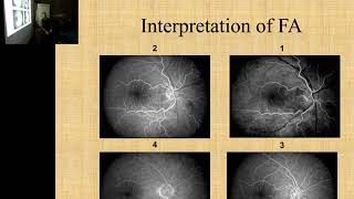 Fluorescein Angiography Dr Mahmood Mekkawy [upl. by Stuart874]