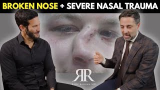 What To Do If You Break Your Nose  Nasal Trauma amp Emergency Rhinoplasty Explained [upl. by Sinnoda]