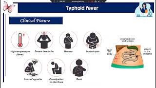 Practical Diagnosis of typhoid fever plague undulant fever [upl. by Adnohsar]