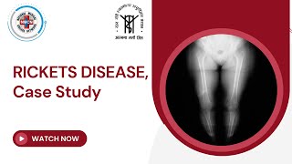 RICKETS DISEASE Case Study [upl. by Cilurzo]