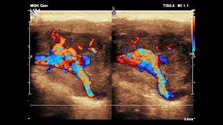 Pleomorphic Adenoma of Parotid Gland  Ultrasound  Doppler  Case 05 [upl. by Tareyn848]