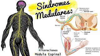 SÍNDROMES MEDULARES repaso y CASO CLÍNICO [upl. by Sirap124]