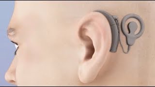 Cochlear Implant Animation [upl. by Adnaluoy315]