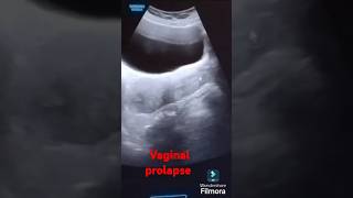 VAGINAL PROLAPSE usg UTERUSRADIOLOGY [upl. by Dnalwor820]