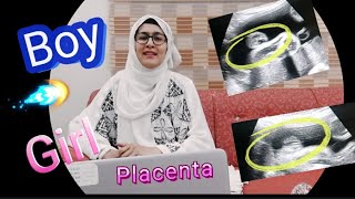 QAs  Anterior Placenta means baby Girl  Posterior Placenta means baby GirlBoy  Fundal Placenta [upl. by Gweneth]