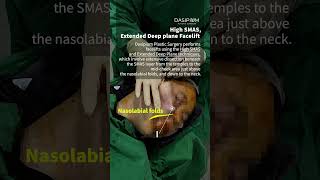 High SMAS Extended Deep plane Facelift koreaplasticsugery smasfacelift DrKwakMinho dasipium [upl. by Jecoa]