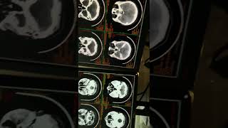 CECT brain  ct scan of head with contrast trending anatomy medicalimaging brain ctscan head [upl. by Siuol37]