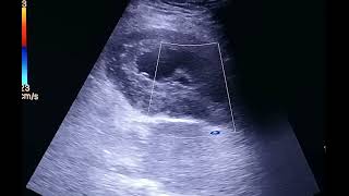 Case of postmenopausal bleeding [upl. by Eseeryt]