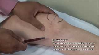 Knee Injection  Medial Approach [upl. by Asilec]