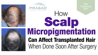 How Scalp Micropigmentation Too Soon after a Hair Transplant can Damage Hair Grafts [upl. by Kacy]