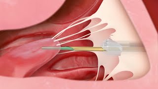 Transcatheter Mitral Valve Repair  Medical Animation [upl. by Elane]