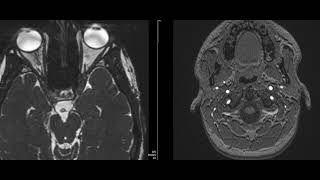 case 22 diplopia and squint [upl. by Immat549]