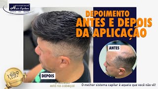 Como é utilizar uma Prótese Capilar AntesDepois  RELATO REAL Intervision Hair System [upl. by Demetrius836]