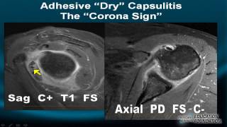 Shoulder Instability on MRI Part III The golden rule of Dynamic Labral Interpretation [upl. by Gerry837]