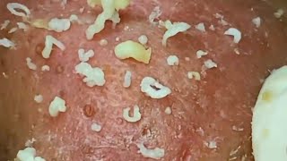 PIMPLE Popping BLACKHEAD REMOVAL 2022 ACNE Treatment TOP RELAXING SPA VIDEO 2022 [upl. by Denbrook776]