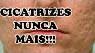 3 DICAS PARA TIRAR CICATRIZ [upl. by Absalom]