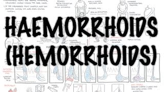 Haemorrhoids Hemorrhoids  Overview pathophysiology investigations and treatment [upl. by Airrehs320]