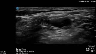 Interscalene brachial plexus block [upl. by Nywroc919]